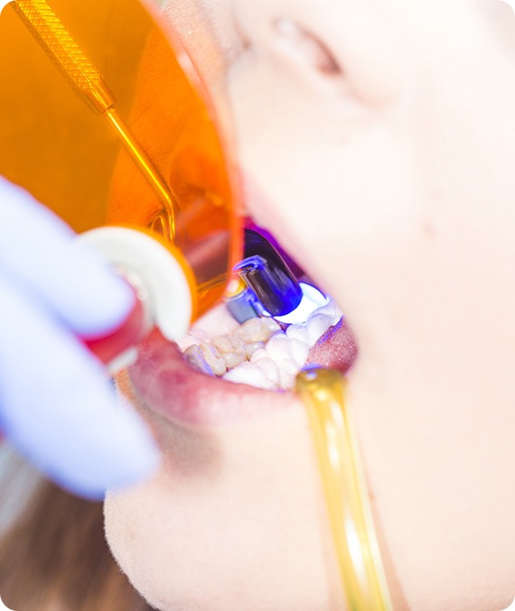 Cosmetic Tooth Bonding | Millennium Dental | General & Family Dentist | SE Calgary