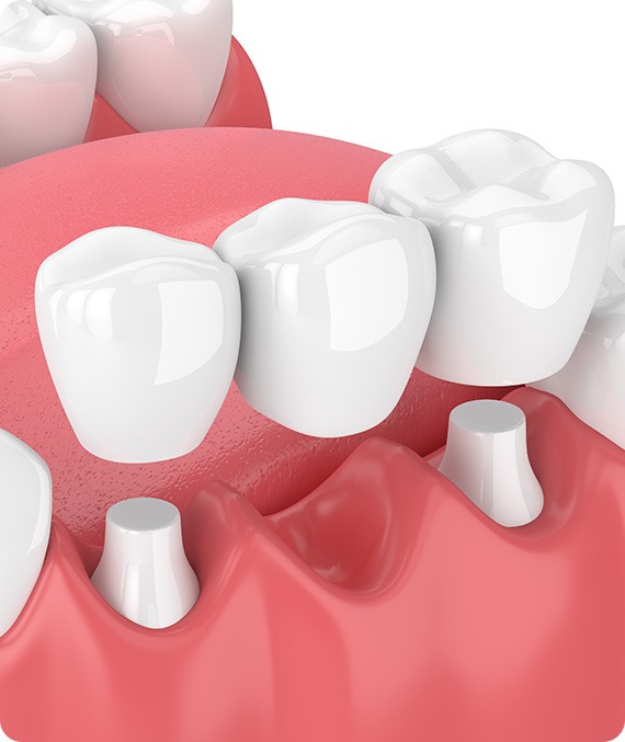 Dental Bridges | Millennium Dental | General & Family Dentist | SE Calgary