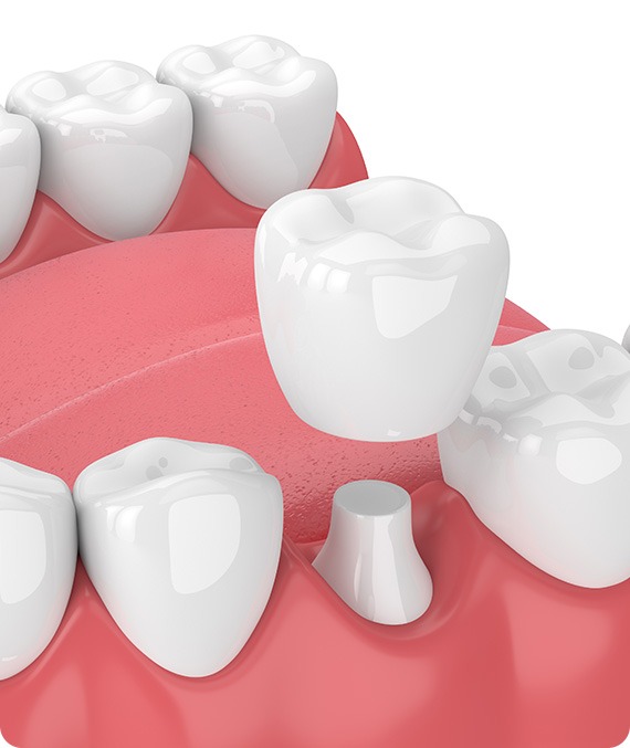 Dental Crowns | Millennium Dental | General & Family Dentist | SE Calgary