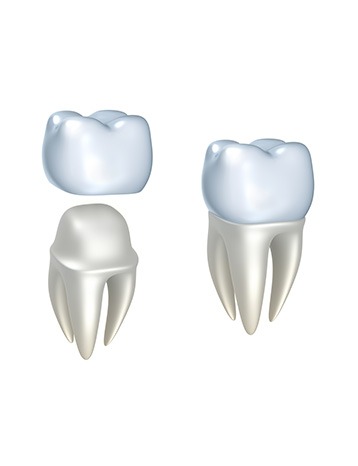 Dental Crowns | Millennium Dental | General & Family Dentist | SE Calgary