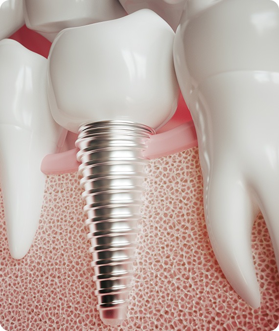 Dental Implants | Millennium Dental | General & Family Dentist | SE Calgary