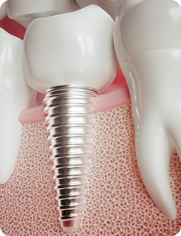 Dental Implants | Millennium Dental | General & Family Dentist | SE Calgary