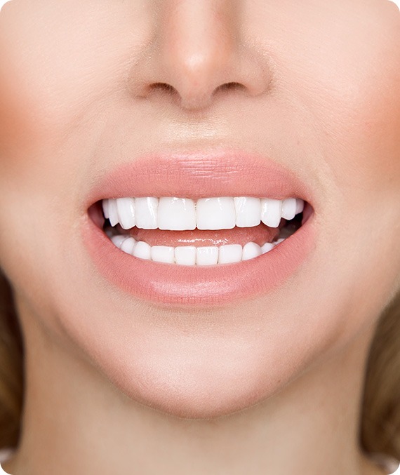 Porcelain Veneers | Millennium Dental | General & Family Dentist | SE Calgary