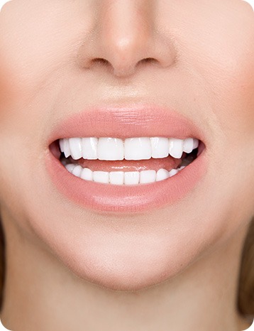 Porcelain Veneers | Millennium Dental | General & Family Dentist | SE Calgary