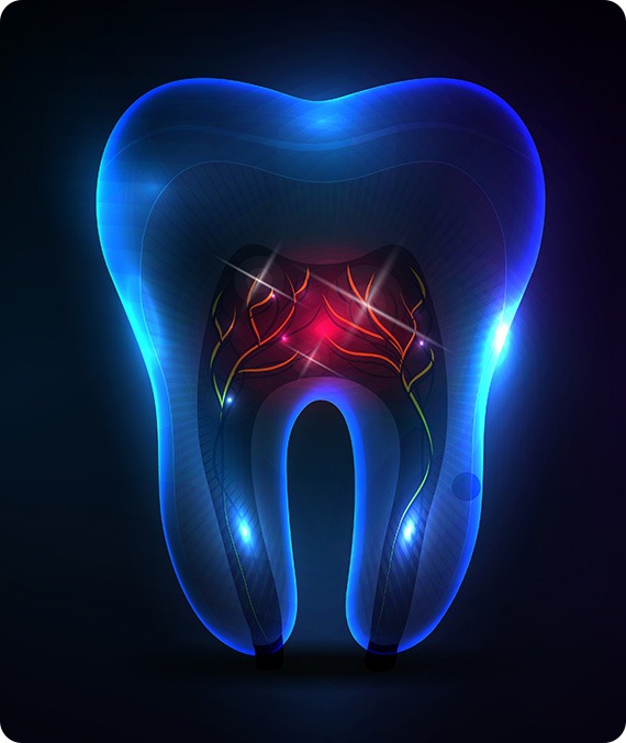 Root Canal Therapy | Millennium Dental | General & Family Dentist | SE Calgary
