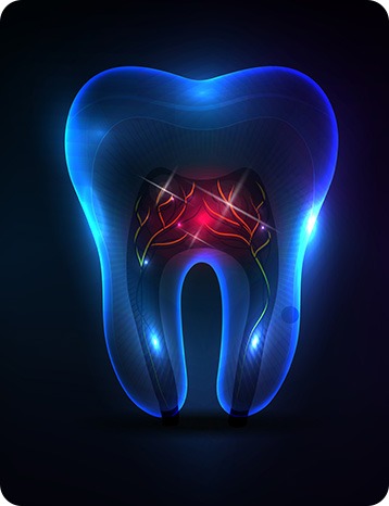 Root Canal Therapy | Millennium Dental | General & Family Dentist | SE Calgary