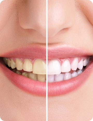 Teeth Whitening | Millennium Dental | General & Family Dentist | SE Calgary