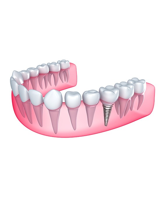 Dental Implants | Millennium Dental | General & Family Dentist | SE Calgary