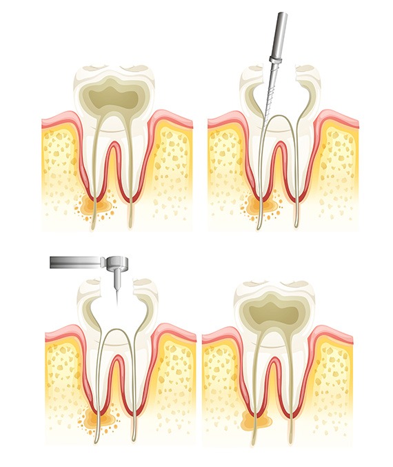 Root Canal Therapy | Millennium Dental | General & Family Dentist | SE Calgary