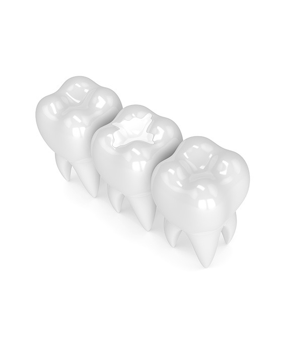 White Filings | Millennium Dental | General & Family Dentist | SE Calgary