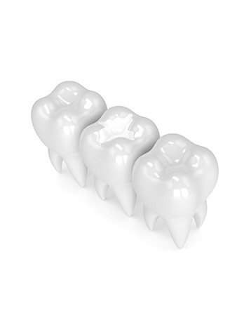 White Fillings | Millennium Dental | General & Family Dentist | SE Calgary