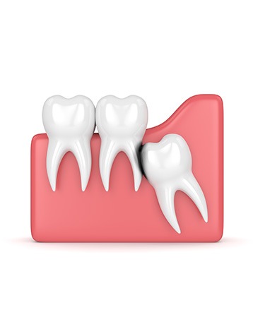 Wisdom Teeth Extractions | Millennium Dental | General & Family Dentist | SE Calgary