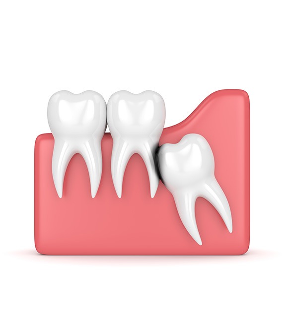 Wisdom Teeth Extractions | Millennium Dental | General & Family Dentist | SE Calgary