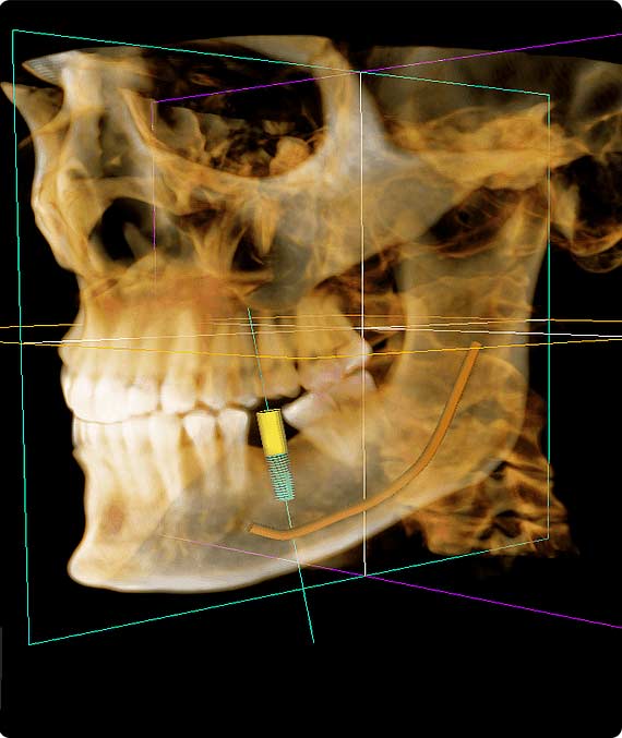 CBCT Scan