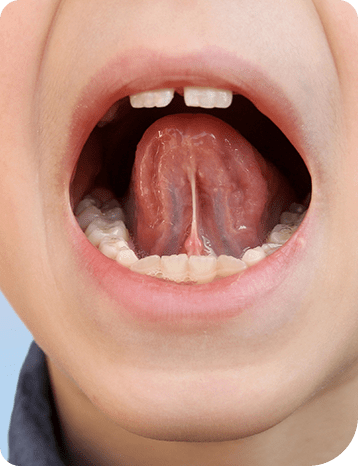 Myofunctional Therapy | Millennium Dental | General & Family Dentist | SE Calgary
